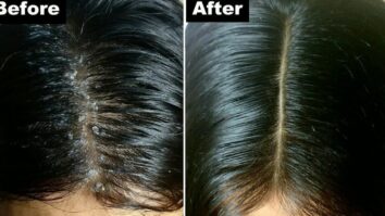 Comment enlever la peau morte du cuir chevelu ?