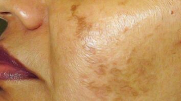 Comment enlever les taches brunes sur la peau naturellement ?