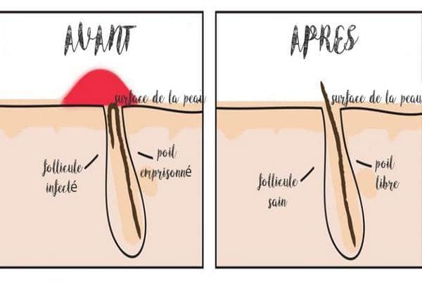 Comment éviter les poils blancs ?