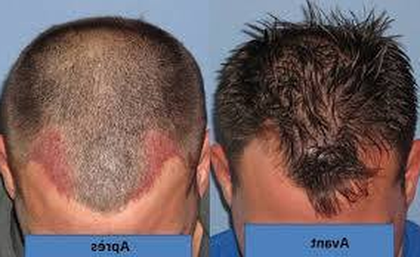 Comment faire pousser les cheveux de la zone frontale homme ?