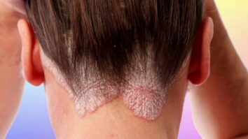 Comment hydrater cuir chevelu trop sec psoriasis ?