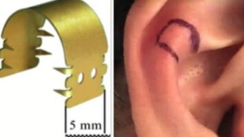 Comment recoller son oreille sans chirurgie ?