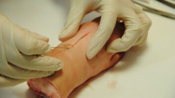Comment refermer une plaie sans point de suture ?