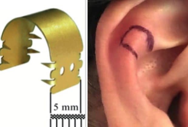 Comment rétrécir ses oreilles sans chirurgie ?