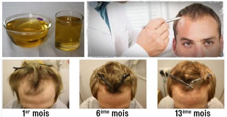 Comment savoir si les cheveux ne repoussent plus ?