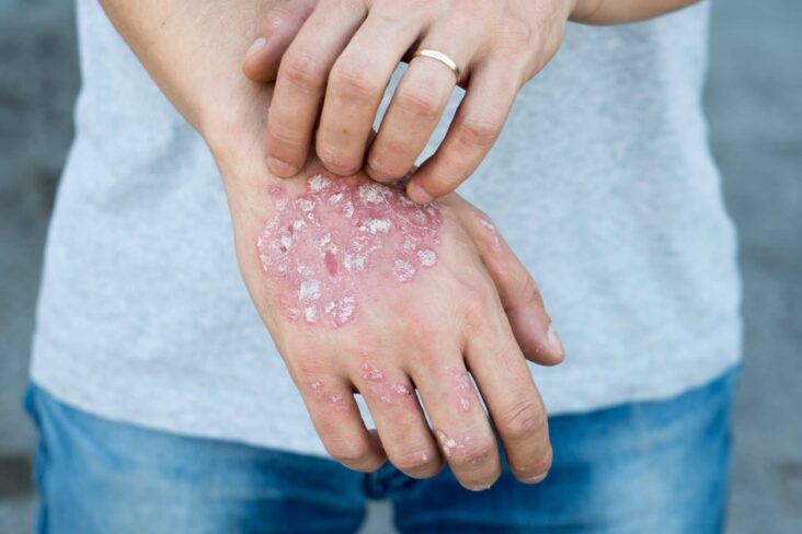 Comment savoir si on a le psoriasis ?