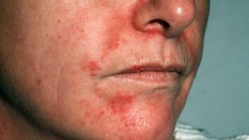 Comment se débarrasser de la dermite séborrhéique ?