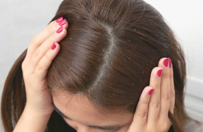Comment se débarrasser de l'eczéma dans les cheveux ?