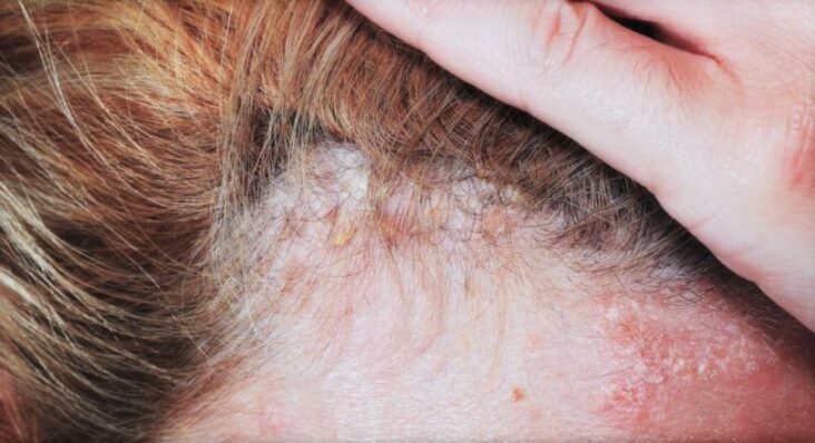 Comment se débarrasser d'un psoriasis du cuir chevelu ?
