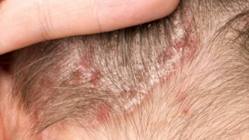 Comment soigner une dermatite du cuir chevelu naturellement ?