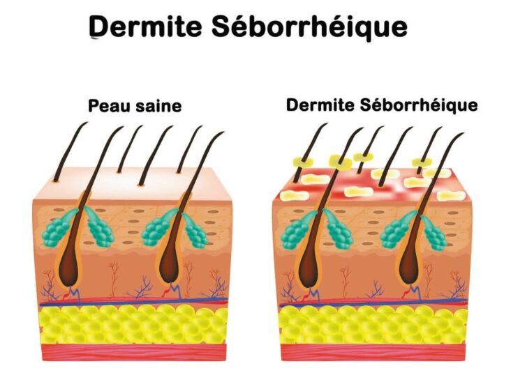 Comment soigner une dermite séborrhéique naturellement ?