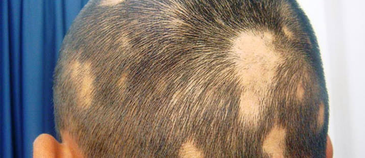Est-ce que la pelade est une maladie Auto-immune ?