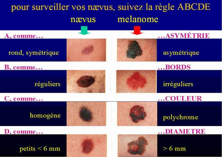 Est-ce que le cancer de la peau gratte ?