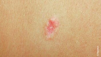 Est-ce que le cancer de la peau se soigne ?