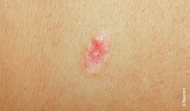 Est-ce que le cancer de la peau se soigne ?