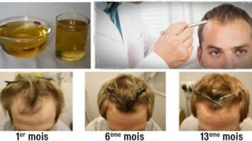 Est-ce que les cheveux peuvent repousser ?