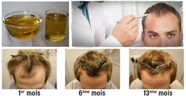 Est-il possible que les cheveux repoussent ?