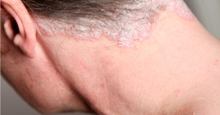 Pourquoi du psoriasis dans le cuir chevelu ?