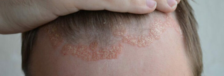 Pourquoi eczéma cuir chevelu ?