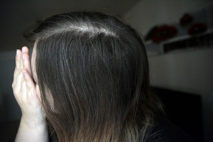 Pourquoi j'ai des cheveux blancs à 13 ans ?
