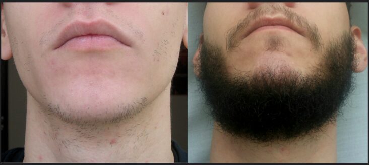 Pourquoi ma barbe ne pousse pas sur les joues ?