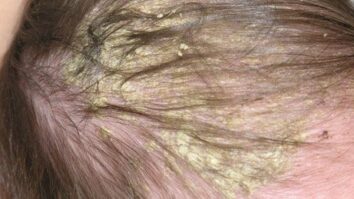 Pourquoi on a des croûtes dans les cheveux ?