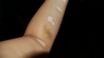 Quand apparaît le vitiligo ?