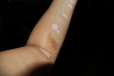 Quand apparaît le vitiligo ?