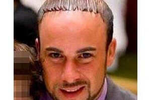 Quel coupe de cheveux quand on a une calvitie ?