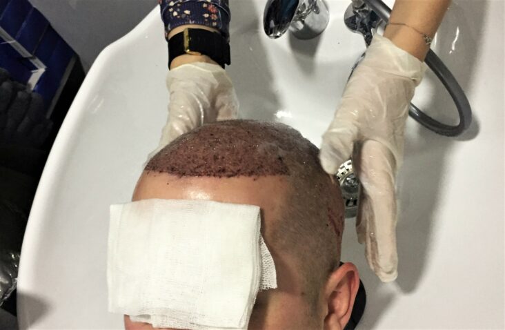 Quel shampoing utiliser après une chimiothérapie ?