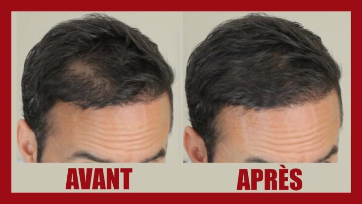 Quelle coupe quand on commence à perdre ses cheveux ?