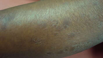 Quelle maladie rend la peau noire ?