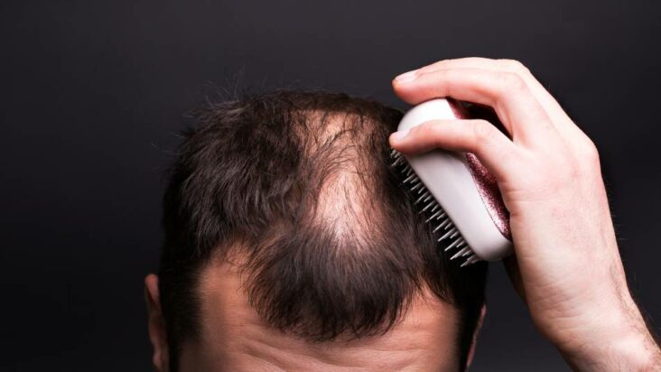 Quelles sont les causes de la perte de cheveux ?