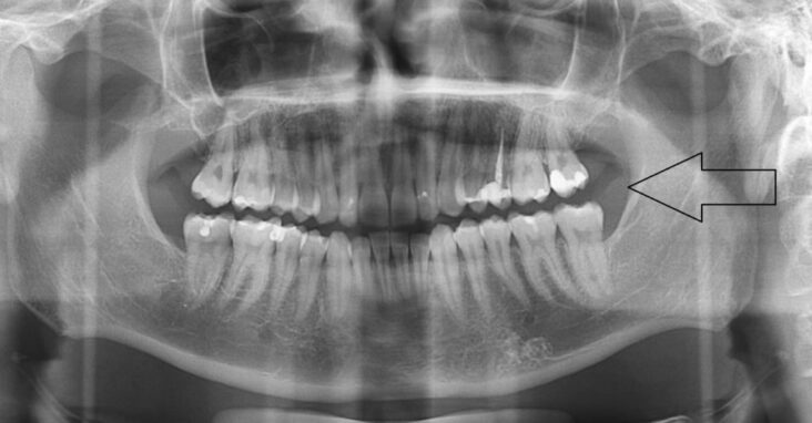 Quelles sont les causes de l'abcès ?