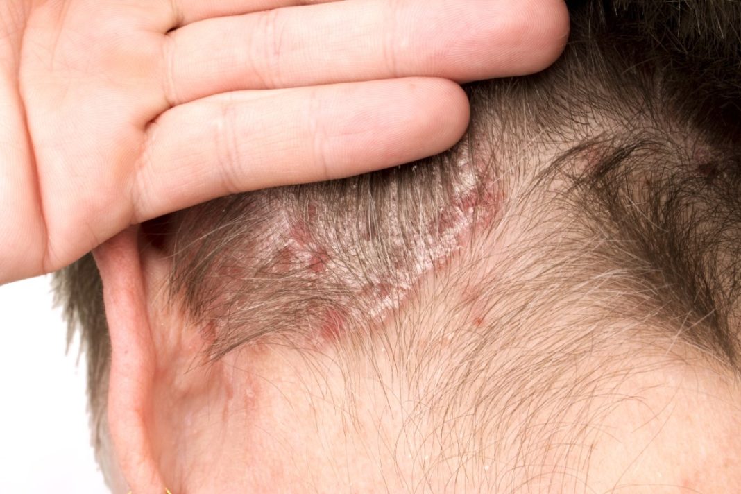 Quelles sont les différentes maladies du cuir chevelu ?