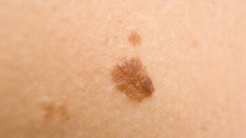 Quels sont les premiers symptômes du cancer de la peau ?