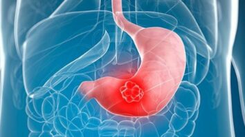 Quels sont les premiers symptômes du cancer de l'intestin ?