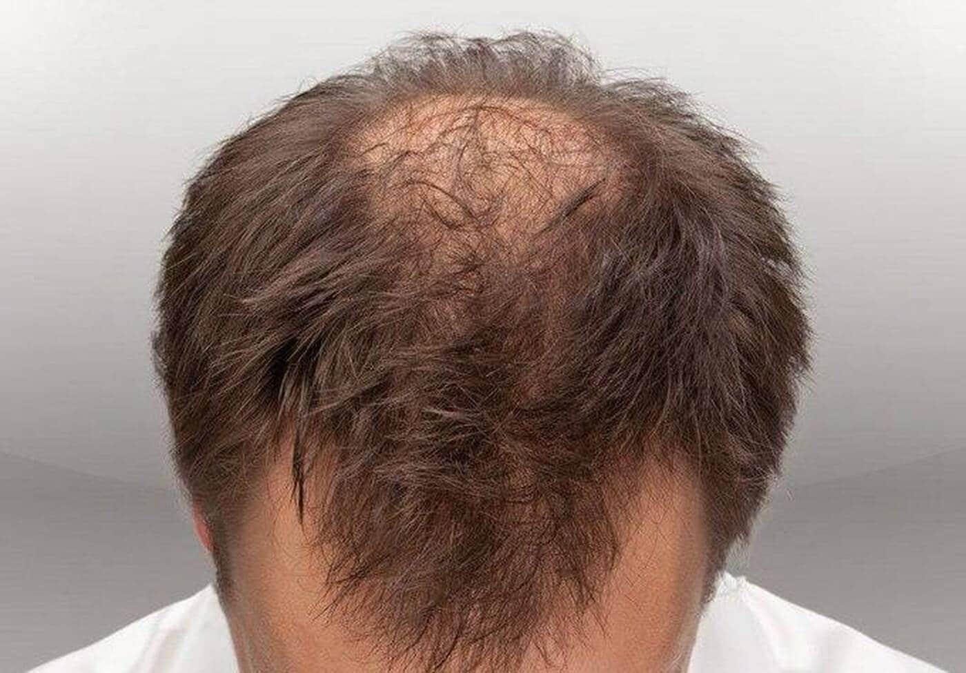 Выпадение волос у мужчин лечение. Стрижки с залысинами на макушке.