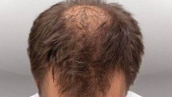 Qu'est-ce qui fait repousser les cheveux ?