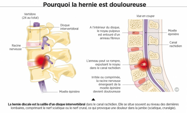 Qui consulter pour le syndrome de la queue de cheval ?
