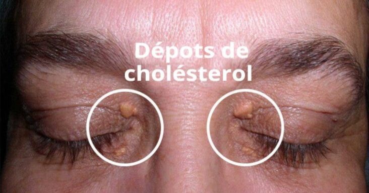 Comment enlever le dépôt de cholestérol autour des yeux ?