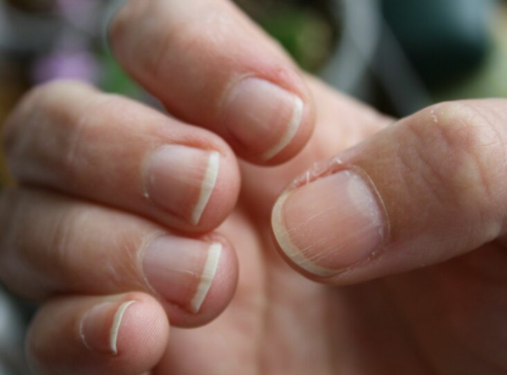 Comment se débarrasser des stries sur les ongles ?