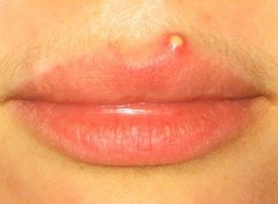 Comment se débarrasser d'un bouton sur la lèvre ?