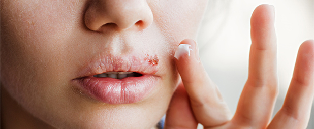 Comment soigner un bouton sur les grandes lèvres ?