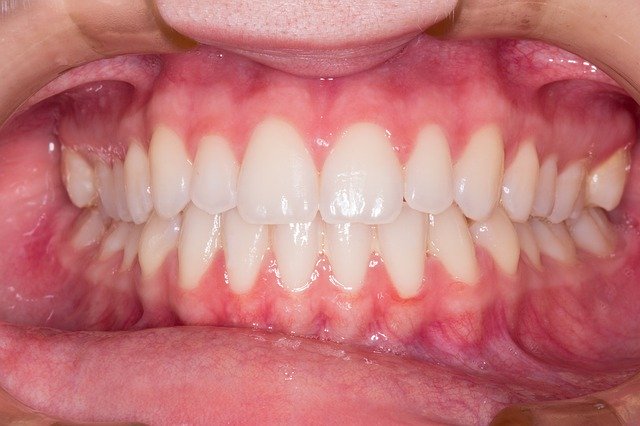 Comment soigner une gingivite sans aller chez le dentiste ?
