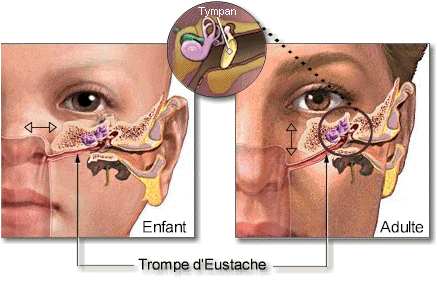 Comment soigner une inflammation de l'oreille interne ?