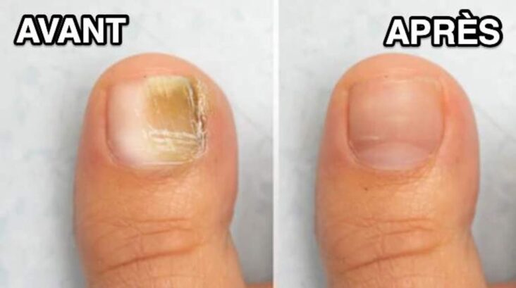 Comment soigner une mycose de l'ongle du gros orteil ?