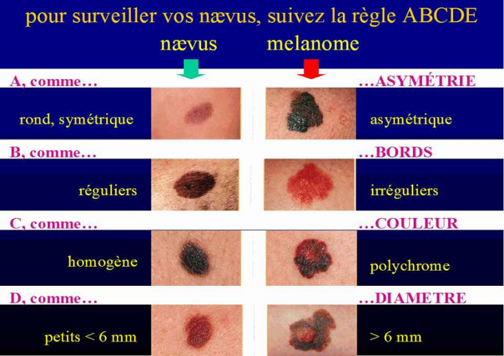 Est-ce dangereux d'arracher un grain de beauté ?