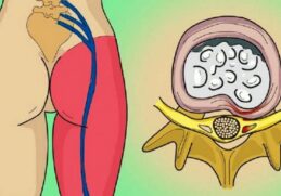 Est-ce que le stress peut provoquer une sciatique ?