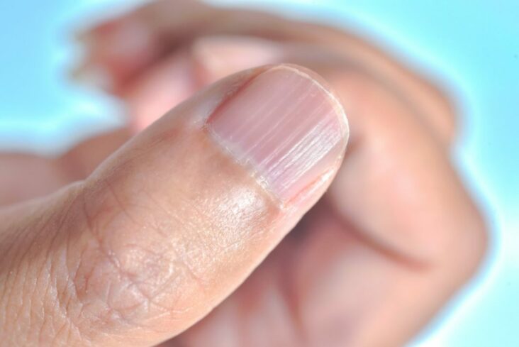 Pourquoi mes ongles ont des stries verticales ?